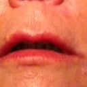my lips 2 weeks after restylane injections