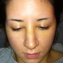 Post op 1 week after Revision Rhino