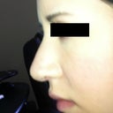 Post op 1 week after Revision Rhino