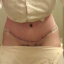 6 days POST OP - looking better.but my back is killing me from being hunched over.