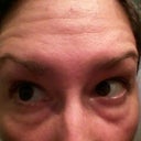 Wrinkles are back, all negative botox side effects show no relief. Getting worse in fact.
