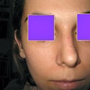 10 days post-op/Revision