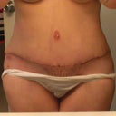 3 weeks PO