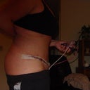 Post op Day 1 Yay my new side view