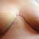 The center is looking great.  The tapes will help lay the scar flat.
