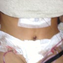 Day 3 Post op