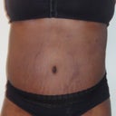 12 Weeks...Still alot of swelling but oh well...i like it!