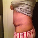 16 days post op - featuring swelling and a seroma. 
:-(