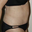 2 weeks-Let the swelling begin!