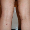 knees - after