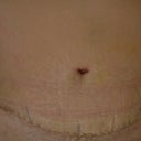 The scar. 3 weeks post op. Very happy!