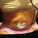 post op day 4 sitting down. Looks and feels like snakes under my skin.