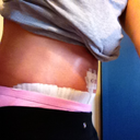 post op day 5