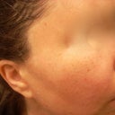 right after procedure