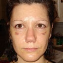 10 days after rhinoplasty. Same shape today.