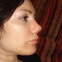 3 months after rhinoplasty