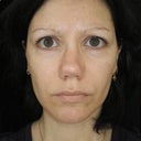 3 months after rhinoplasty. Twisted, retracted columella.