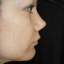 profile after rhinoplasty (no columella, excessive turn up)