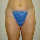 Feb. 2011 Pre-Op Picture