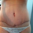 Scar tummy - 3 weeks post op