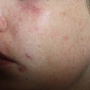 breakouts, uneven skintone, redness under eyes