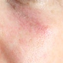 under eye redness