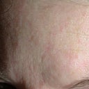 forehead