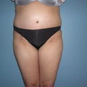 Week 3 post-op