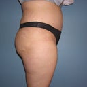 Week 3 post-op