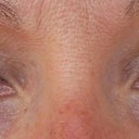 Eyelids 9 months post op  after upper Blepharoplasty. Completely different!!