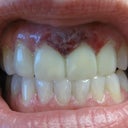 After - My teeth are not white enough for this type of damage