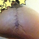 My scar , slowly healing