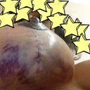 The swollen boob. It was worse before lol , bruising slowly diminishing .