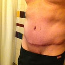 POST OP ALMOST 3 MONTHS.