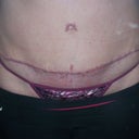 scar right after vbeam treatment