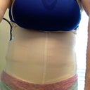 Garment right after surgery