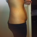 side view 2 weeks pre op