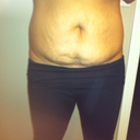 front view 2 weeks pre op