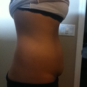 another side view 2 weeks pre op