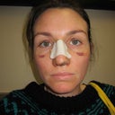 at the office moments before cast removal