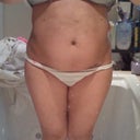 After Lipo