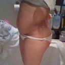 After Lipo Side