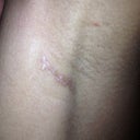Left armpit incision