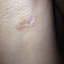 Right armpit incision