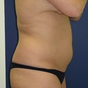 Side view before