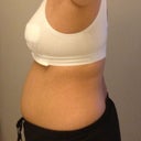 1 day post op side view with surgical bra.
3/9/2012