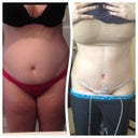 Before vs. 1 week post op