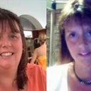 Before and After Gastric Bypass
