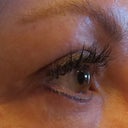 Three full weeks right eye - bruising is gone