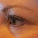 Three full weeks left eye - in my opinion looks better than the right, but time will tell